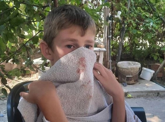 Albanci pretukli srpskog dječaka (12) u Mitrovici, mališan završio u bolnici