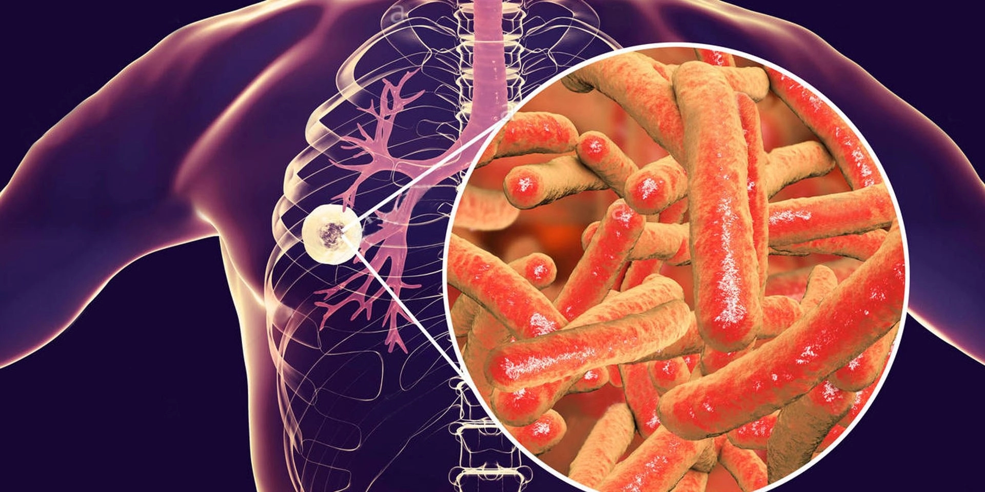Sve manje oboljelih od tuberkuloze