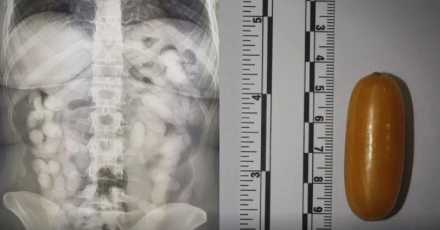 Brazilka uhapšena u Zagrebu “izbacila” kilogram kokaina iz tijela: Deset dana pila laksative